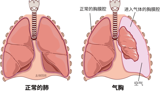 著名歌手因气胸去世!医生提醒:这些人群要注意→(图2) 2.jpg