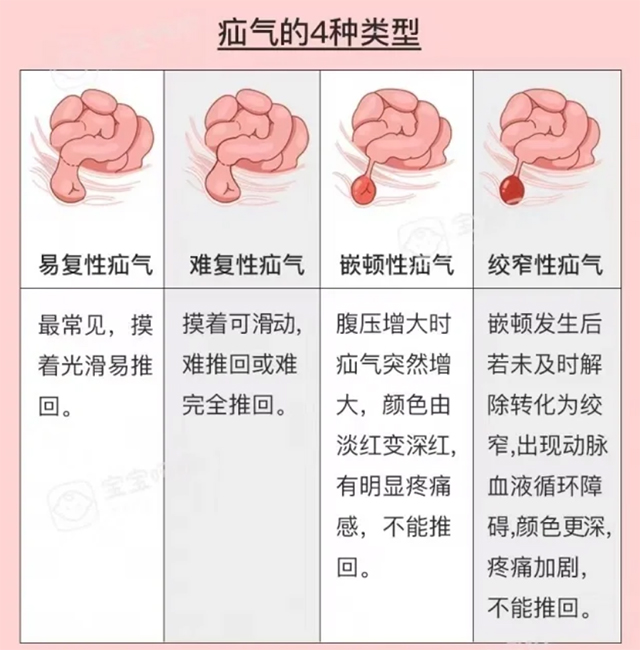疝气不“善”,切莫忽视肚子里的小漏洞!(图11) 11.jpg