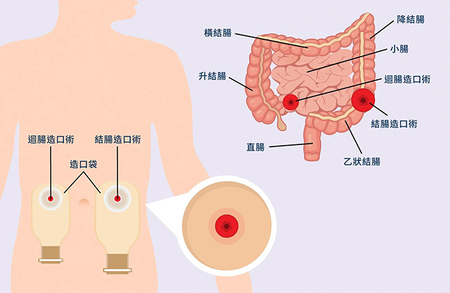 【关注】患直肠癌,男子装上了人工肛门……(图2) 2.jpg