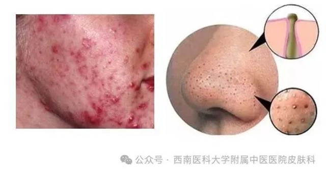 【关注】19岁小伙脸上疯狂“爆痘”,满脸“疙瘩”!(图3) 3.jpg