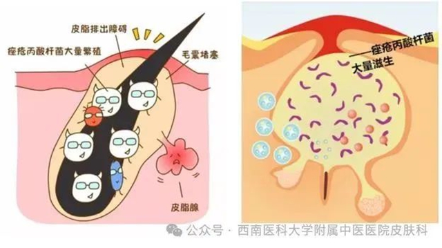 【关注】19岁小伙脸上疯狂“爆痘”,满脸“疙瘩”!(图5) 5.jpg