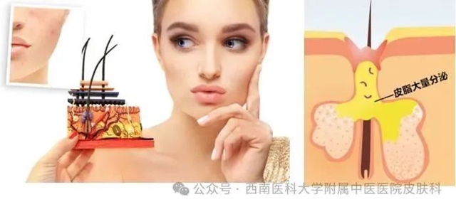 【关注】19岁小伙脸上疯狂“爆痘”,满脸“疙瘩”!(图4) 4.jpg