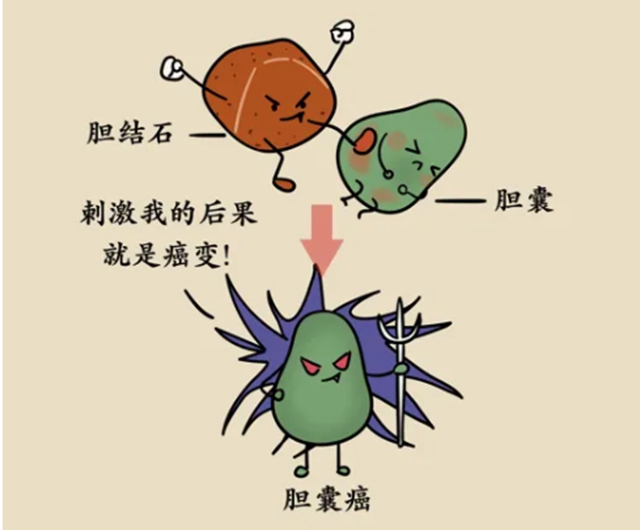 【警惕】晚饭后腹部剧痛不止，胆囊被嘎掉，有这些情况要当心！