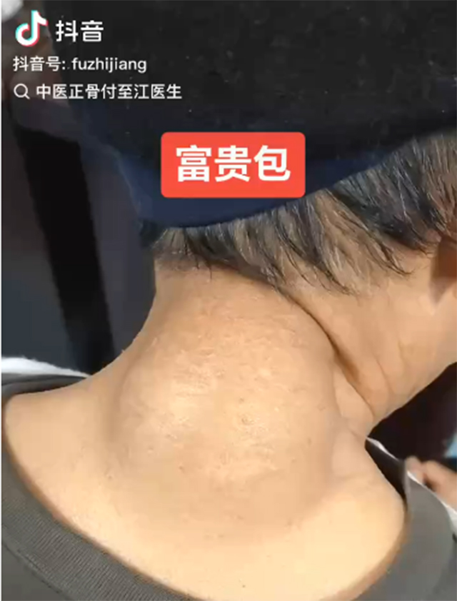 【围观】超大块“富贵包”，就像往后脖颈塞了块面包！