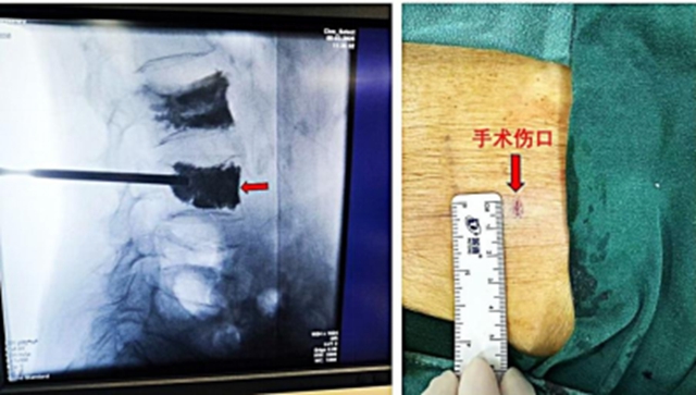 骨折的93岁奶奶躺着进来→走着出去,秘密竟是打了“水泥”(图6) 6.jpg