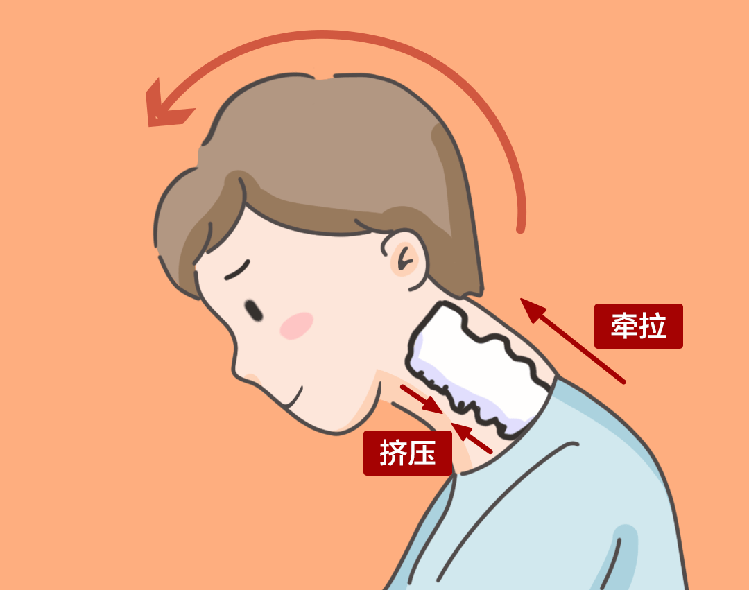 【警惕】长时间低头玩手机？怪不得经常头痛……