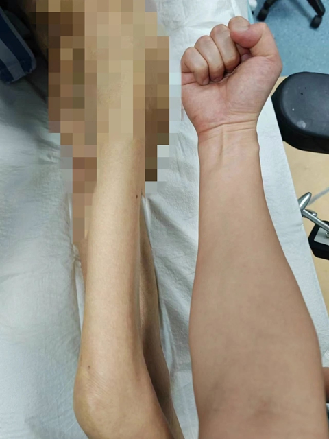 体重仅有60斤左右，瘦骨嶙峋的老人骨折了······