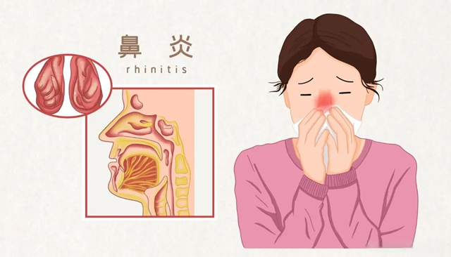 鼻炎老火？试试这个“鼻炎天下第一针”！