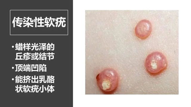 去了趟水上乐园,脸上、大腿长满“小肉粒”! 大人、两娃都中招……(图4) 4.jpg
