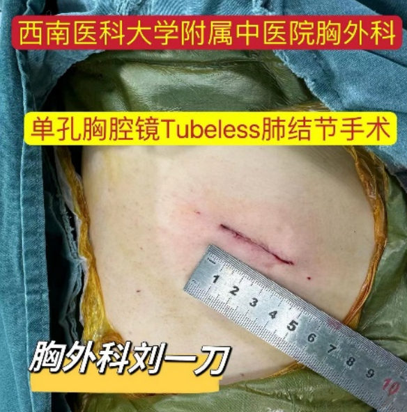泸州4人发现肺结节，一人一个样