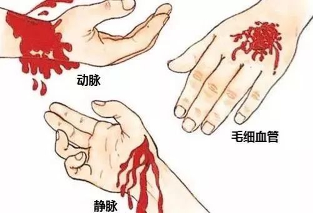 警察光荣牺牲!被刺中大腿动脉还可以抢救吗?(图5) 64008.jpg