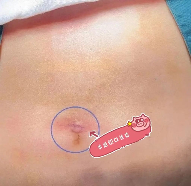 【告别疤痕烦恼】这项特色手术，让云南患者跨省“打卡”