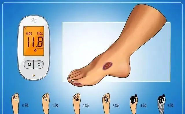 【警惕】一次小烫伤，差点被截肢！这个教训太深刻