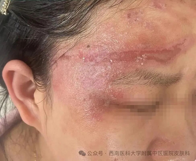 【警惕】泸州美女被虫子“泼硫酸”，差点毁容！