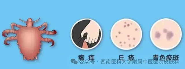 阴虱！反复清洗，挠出红疹