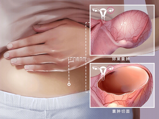 【科普】卵巢囊肿=癌症？别慌！妇产科医生为您揭秘真相！