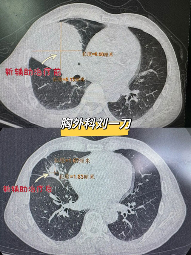 3个月，肿瘤缩小80%