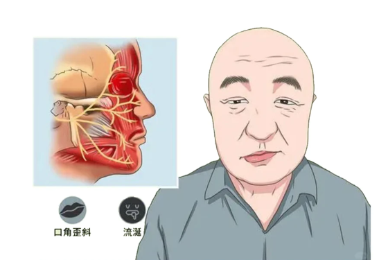 【技术】面瘫有救了！超声引导下的“神经阻滞术”，精准治疗加速康复！
