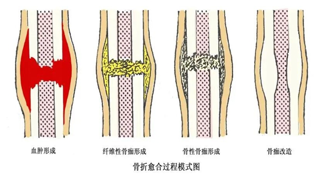 【科普】新鲜骨折 vs 陈旧骨折，靠什么检查 “辨真假”？