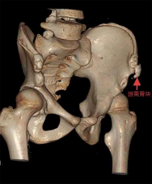 泸州3名学生突发髋痛……