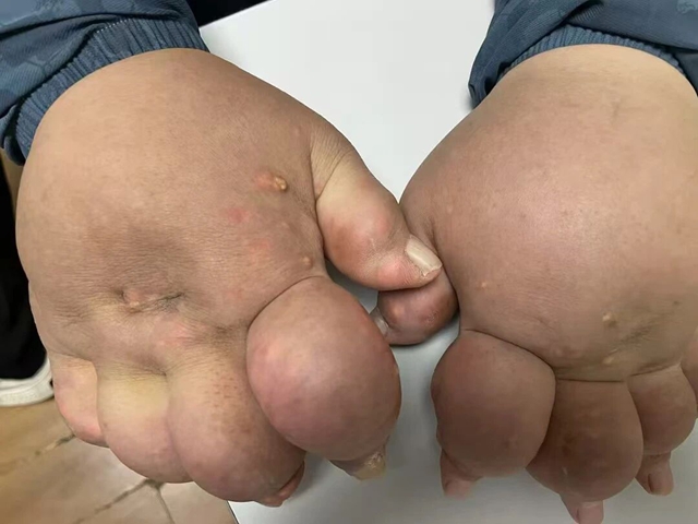 全身长满石头，双手练成“铁砂掌”