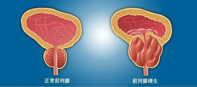 新技术，直接把前列腺“汽化”掉？