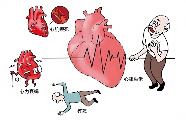 科普丨做了心电图、心脏彩超为啥子没查出冠心病？