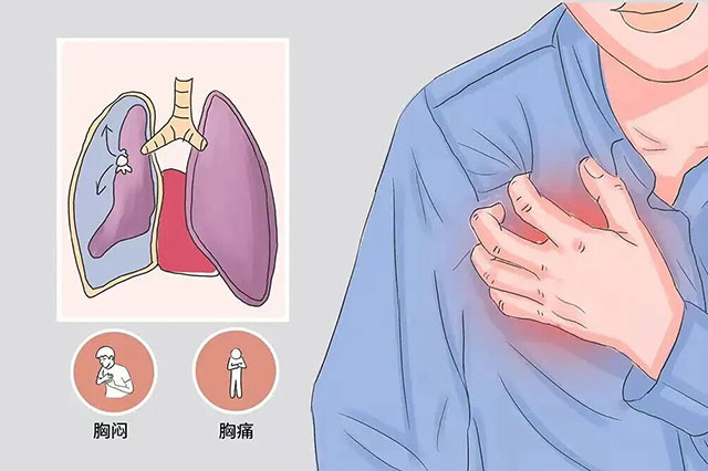 运动后突发胸痛?当心气胸“偷袭”!(图2) 2.jpg