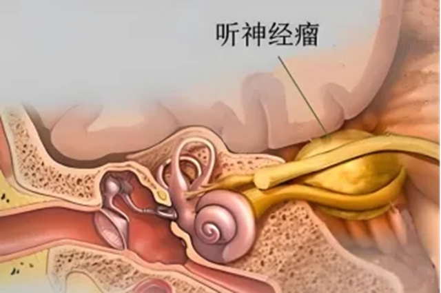 【科普】别把耳鸣当小事！这些信号可能是听神经瘤警报