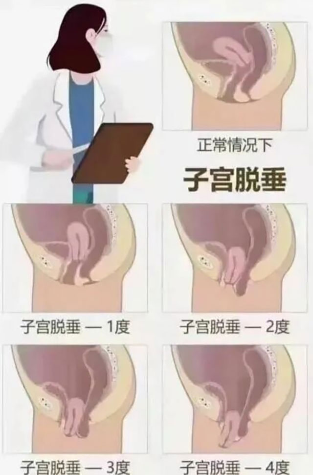 生了娃后,女子子宫从阴道掉出来了(图4) 4.jpg