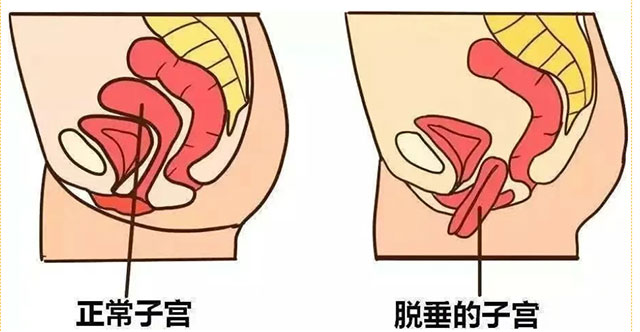 生了娃后,女子子宫从阴道掉出来了(图5) 5.jpg