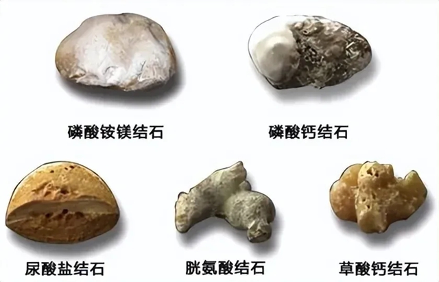 结石3.jpg