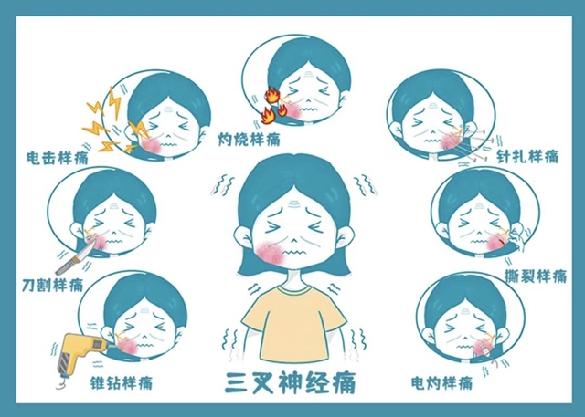 三叉神经痛不用忍！合江县中医医院微创技术精准应对