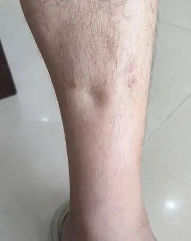 29岁突然确诊尿毒症！半年前早有征兆却被忽视