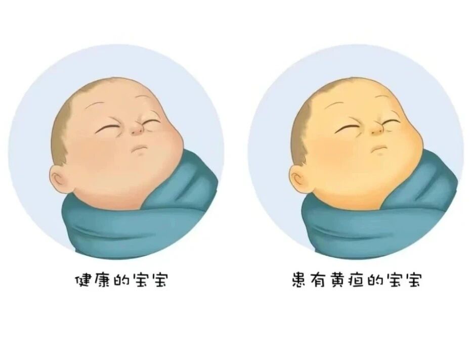 十个宝宝九个黄，新生儿黄疸“退黄宝典”来啦！