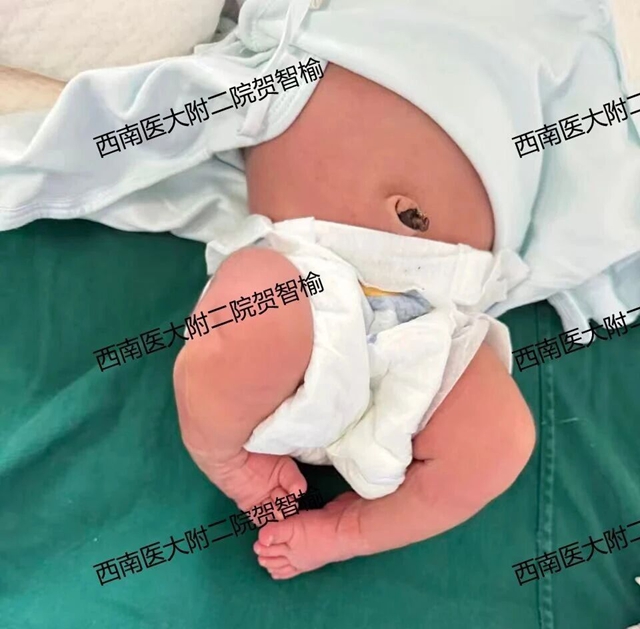 20个宝宝出生就内翻！3年后，这样的“马蹄足”都……