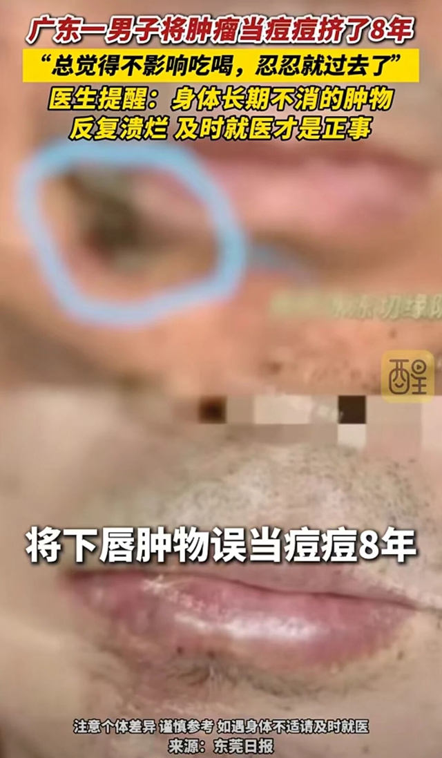 一男子将肿瘤当痘痘挤了8年，溃烂渗液……