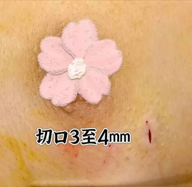 30岁查出乳腺结节，要不要手术切除？1万余例手术结果的建议是……