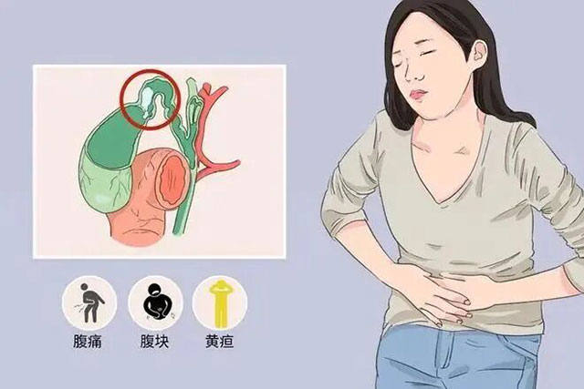 男子胆囊结石30年无症状,第1次发作就已成癌王(图3) 3.jpg