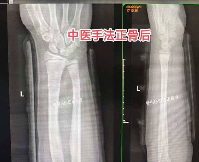 多名小孩手臂被da弯,结果……(图7) 7.jpg