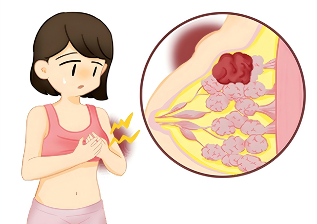 查出乳腺癌后，除了手术和化疗，中医药能做什么？