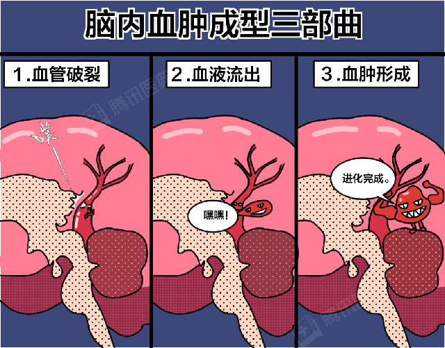 【科普】29岁，脑出血！您还敢熬夜？