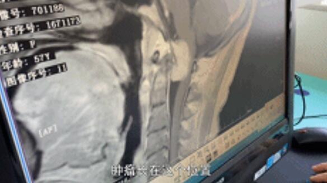 开始只是手指发麻，一查竟是颅内肿瘤！差点就瘫痪……(图3)