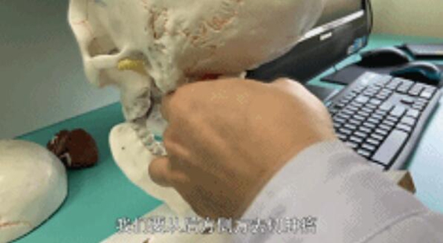 开始只是手指发麻，一查竟是颅内肿瘤！差点就瘫痪……(图4)
