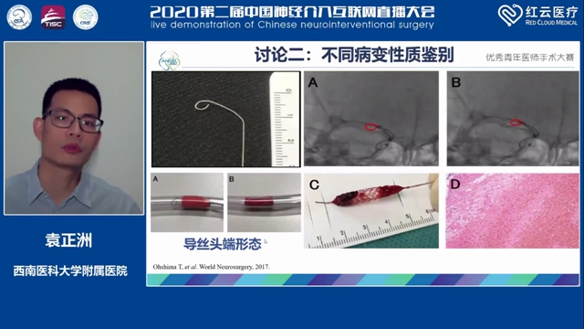 西南医大附院脑卒中团队袁正洲博士再次斩获全国冠军！(图3)