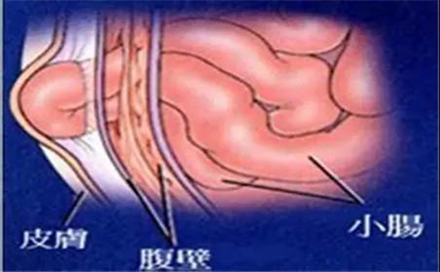 【厉害】指甲盖大小手术切口治疗疝气！