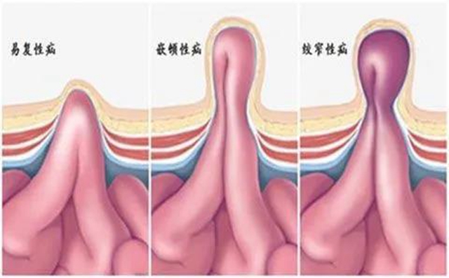 【厉害】指甲盖大小手术切口治疗疝气！(图8)