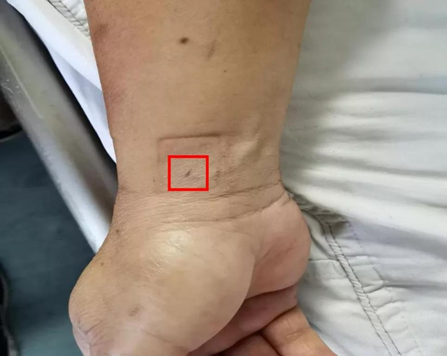 【扩散】针眼大的口子，就能检查脑血管病？(图5)