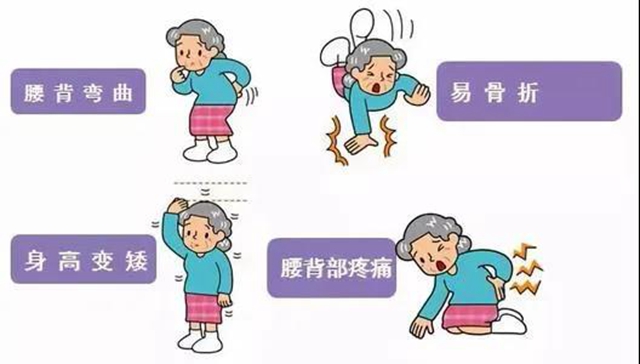 【扩散】只要1分钟，测测你患骨质疏松的风险？