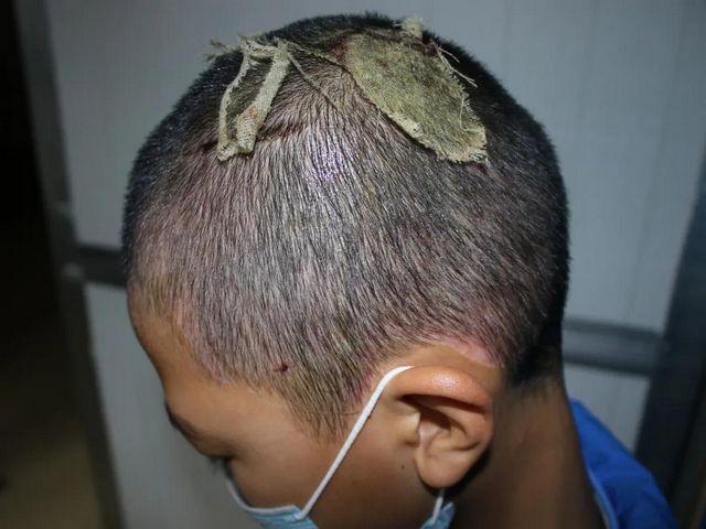 哥哥严重烧伤，7岁双胞胎弟弟捐头部皮肤不叫一声疼！